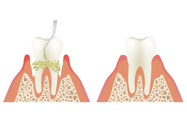 歯周病治療